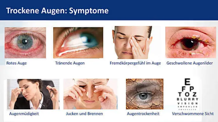 Trockene Augen Symptome Trockene Augen Symptome